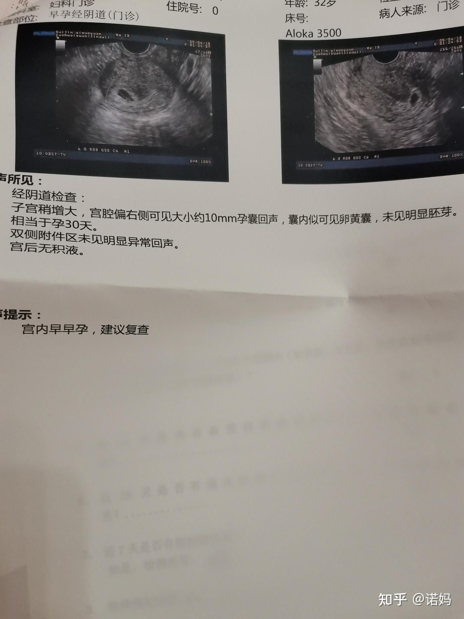 藥流歷時43天堅持不清宮最終排出30mm大殘留帶圖分享給迷茫的姐妹們