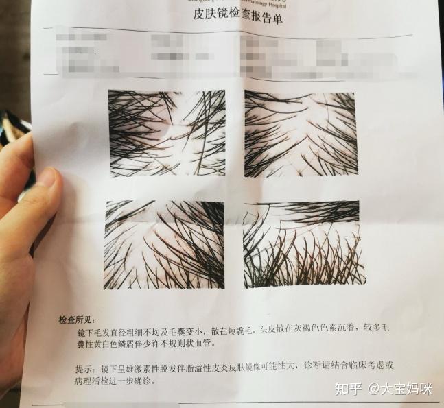 先交代一下我个人的情况(结合毛囊镜检查结果):整整2个月养护头发实拍