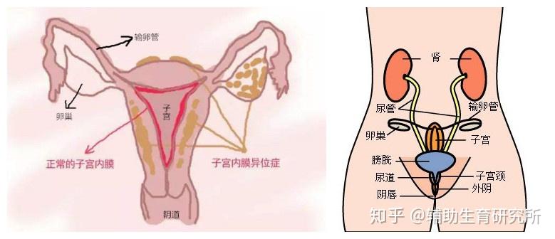 异位的子宫内膜可能生长在子宫外壁,卵巢和输卵管上,甚至在你的膀胱或