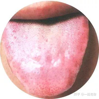 最全的舌诊图谱,附治疗方案,建议收藏 - 知乎