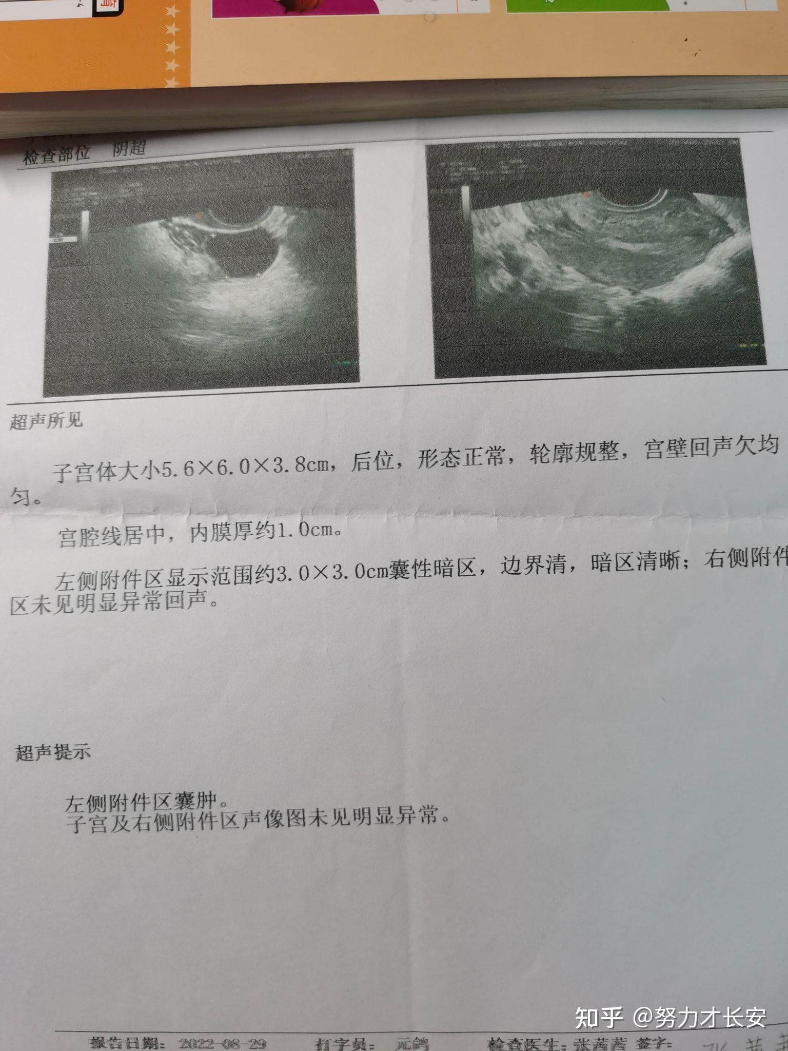 病理性缩复环超声图片图片