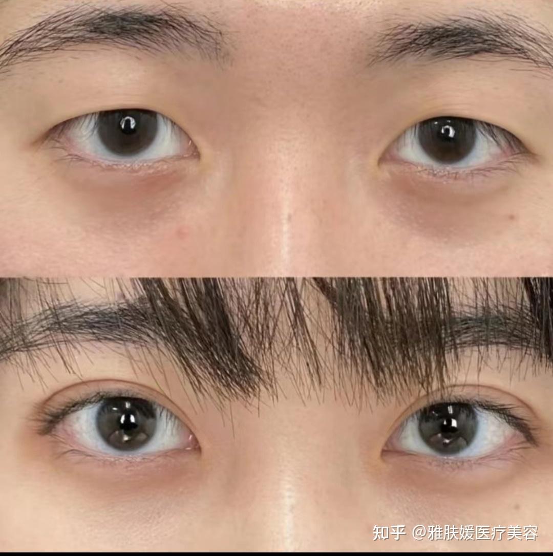 双眼皮手术:通往美丽之路 - 知乎