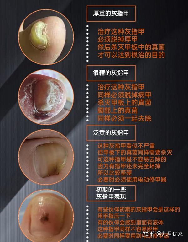 修不好指甲,任何药物都到达不了甲板下,这样就导致灰指甲难以根除