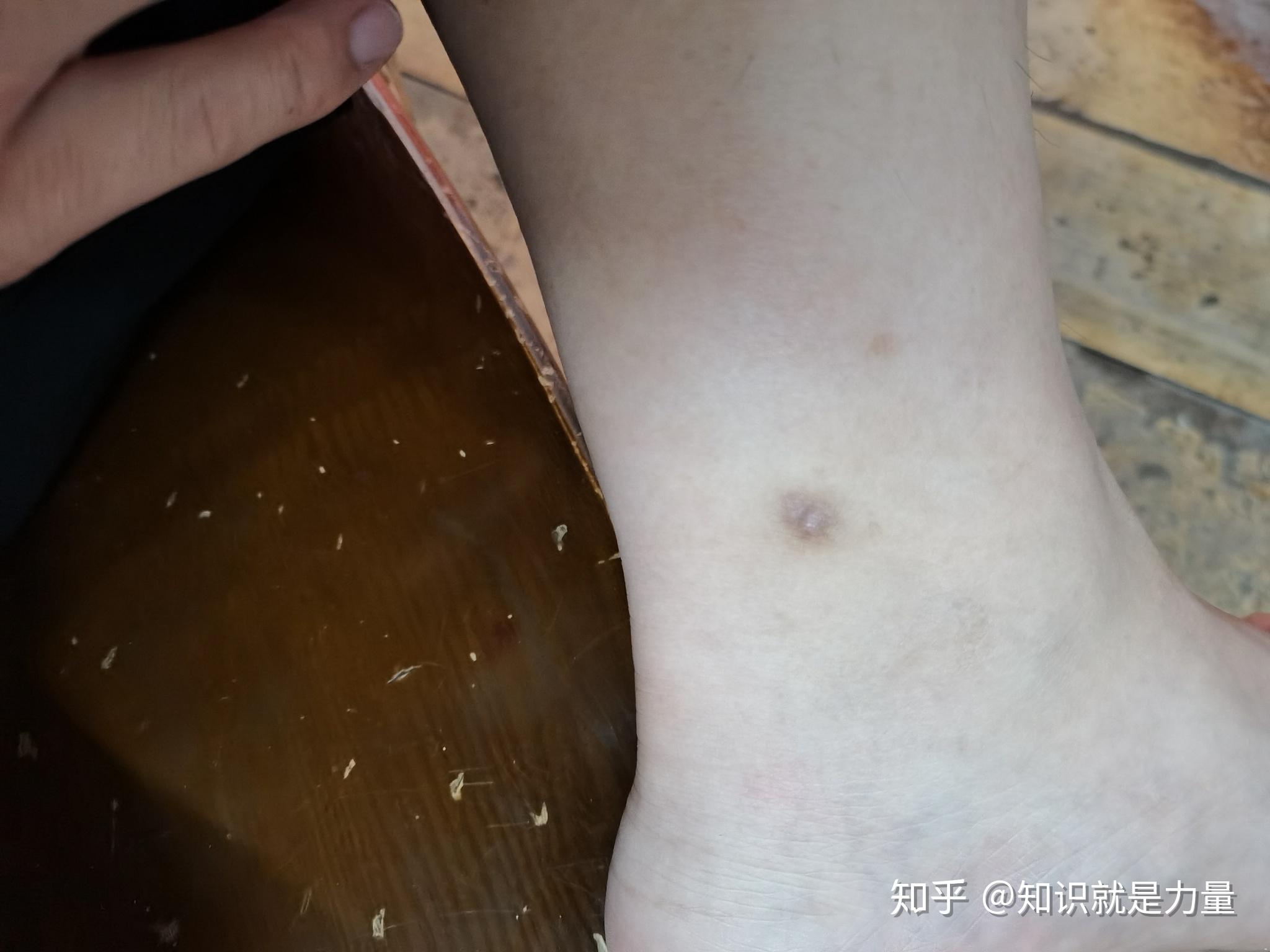 被蚊子虫子咬过挠过留疤了怎么办