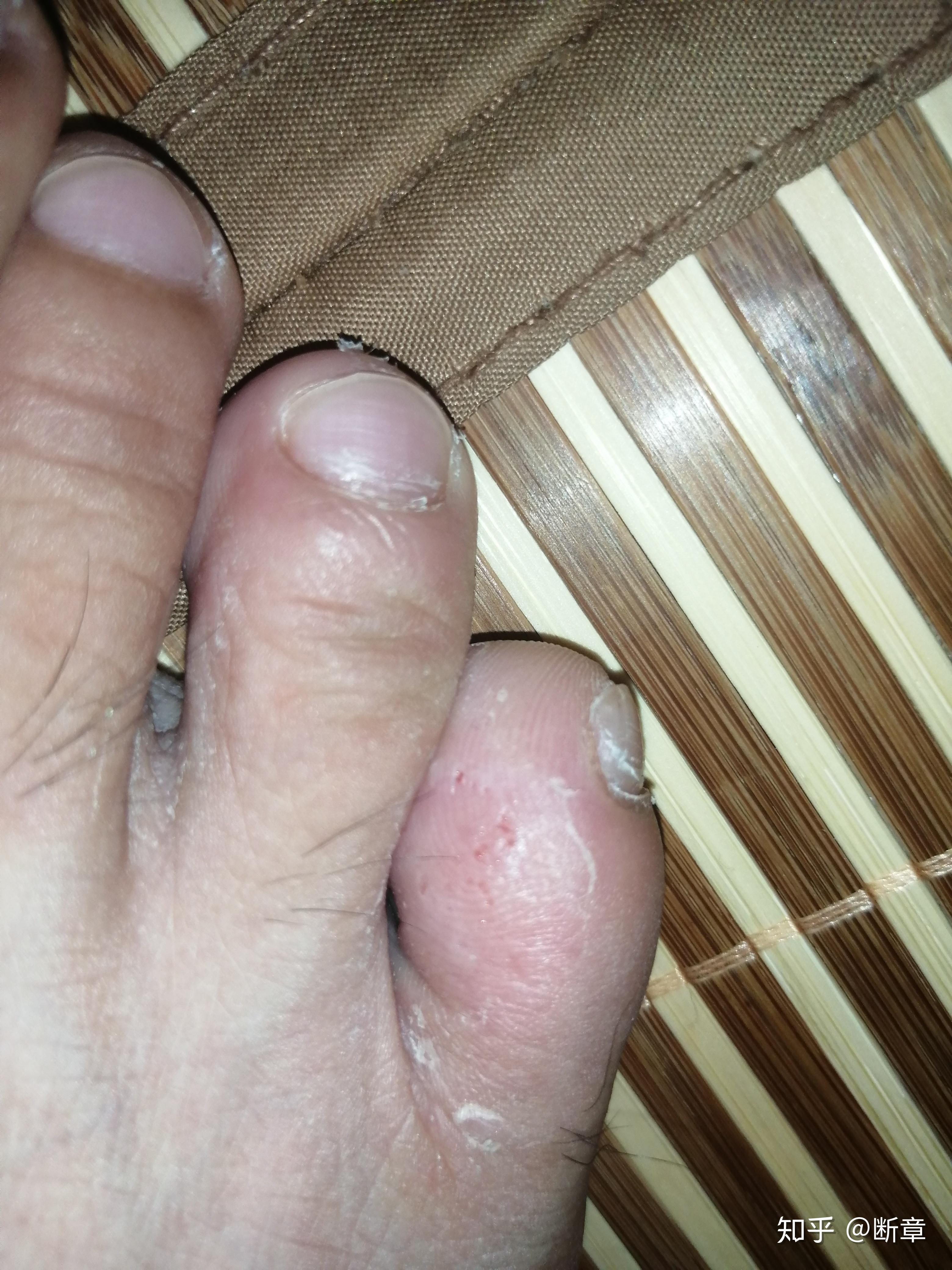 我的脚趾最近很痒,是细菌吗?应该怎样治疗?