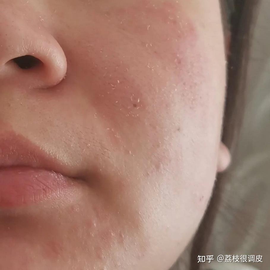 敏感肌泛红,怎么改善?可以去角质吗?