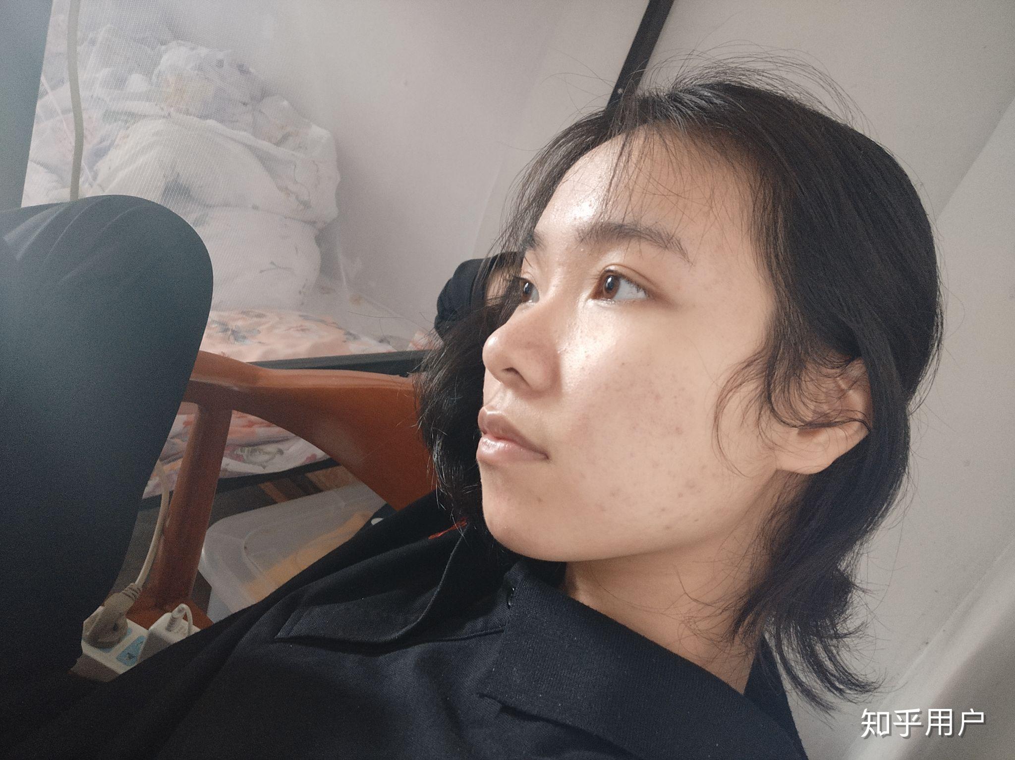 侧脸好看 但是正脸鼻翼大的脸型不好看,怎么办?