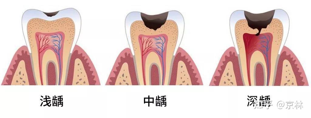 患了龋齿若不进行及时治疗,病变就会越来越大,从浅龋发展到深龋,对