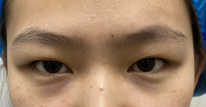 肿泡眼内双怎么改善