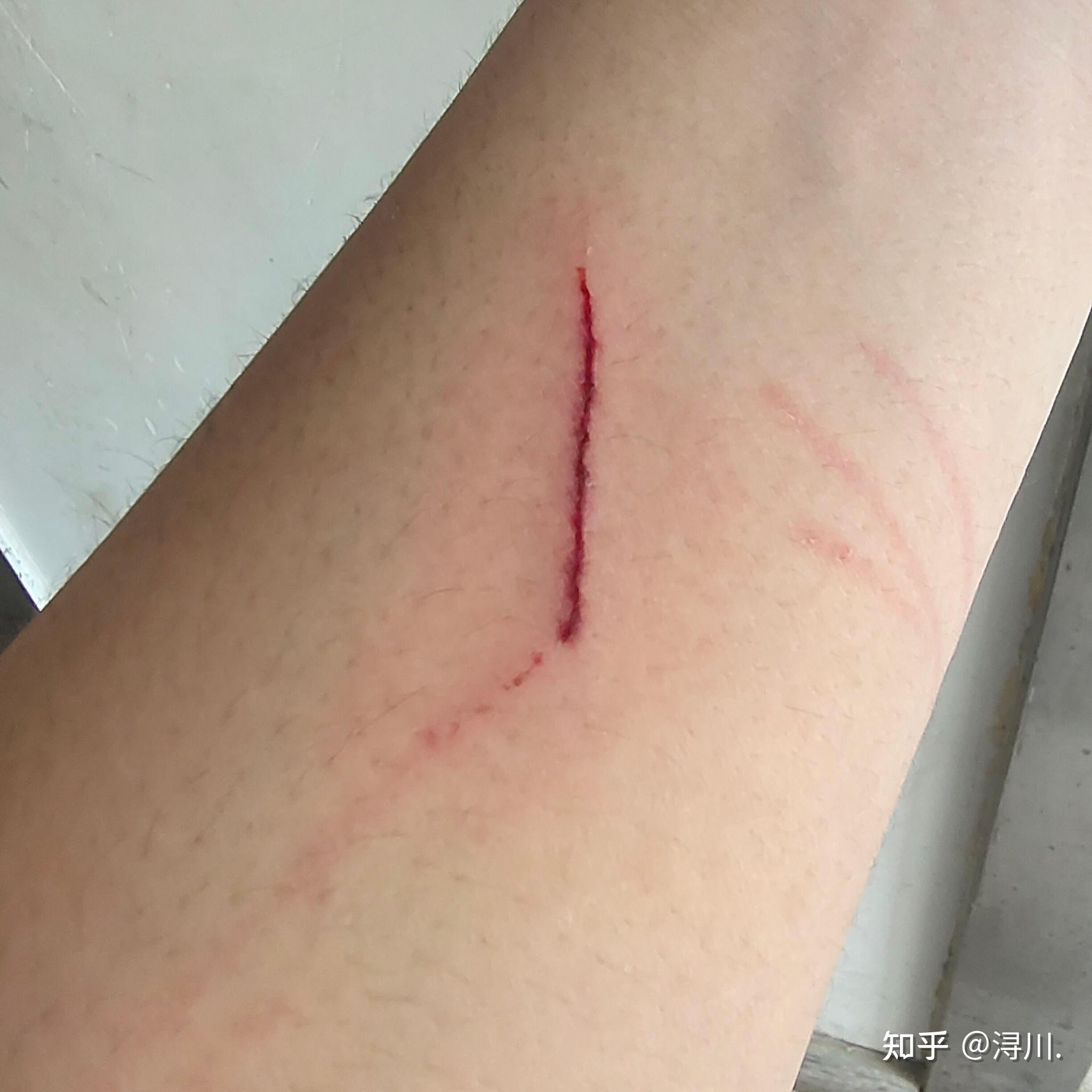 狂犬疫苗没打完又被猫抓