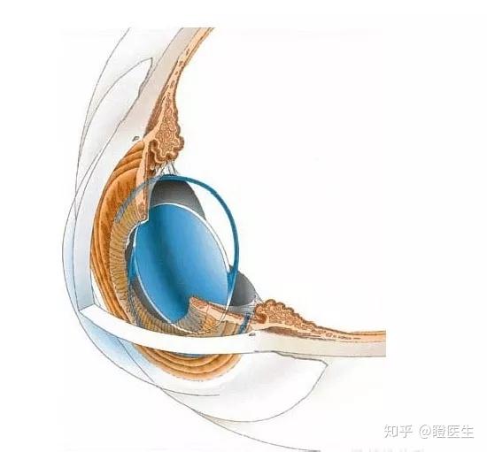 人工晶体脱位不用愁一招即修复