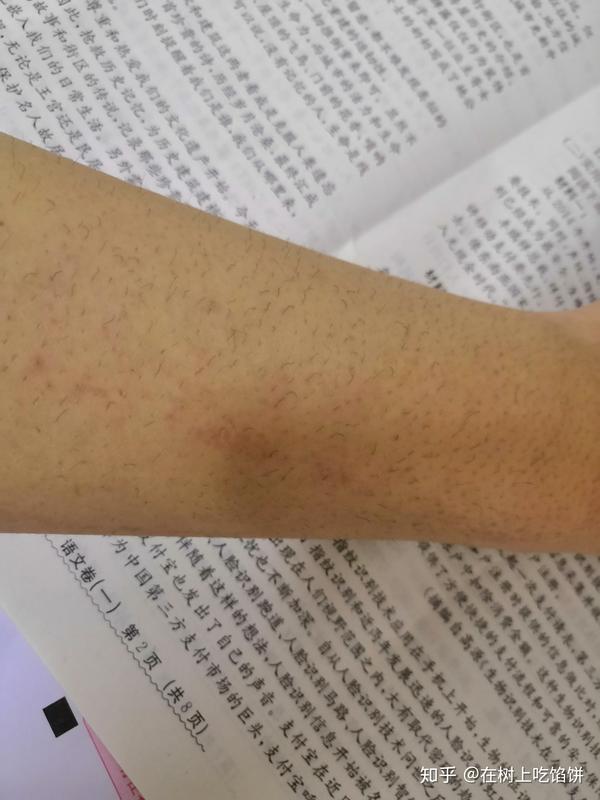 Silk N家用脱毛仪使用记录与心得 知乎