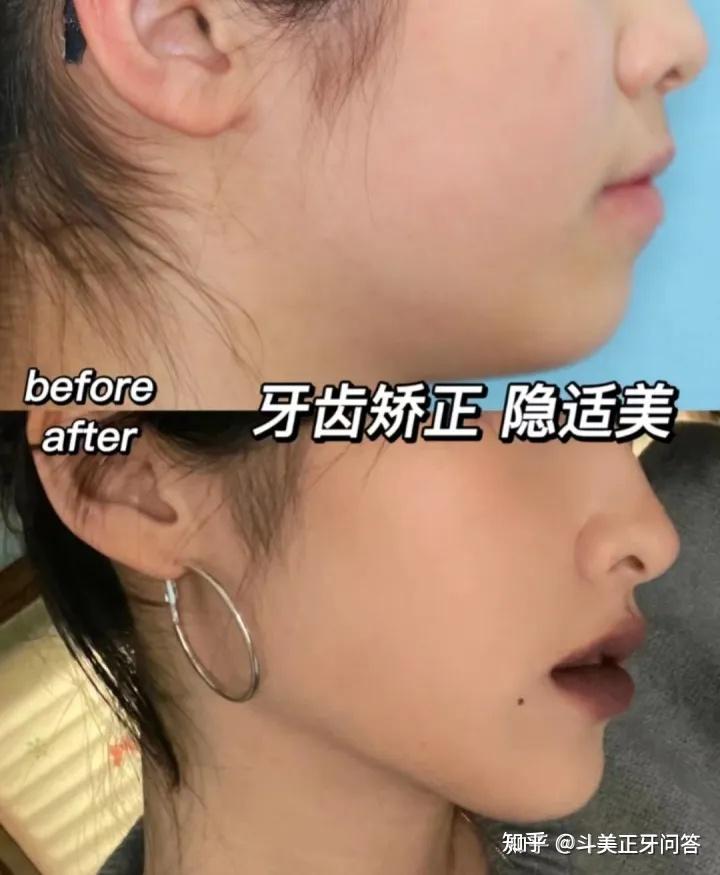求问杭州有没有比较好的矫正牙齿的医院医生?