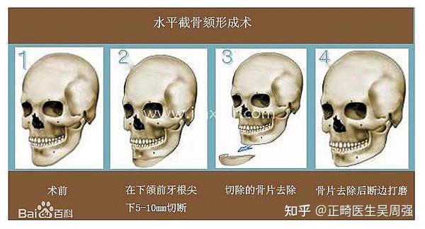常见的正颌手术 - 知乎