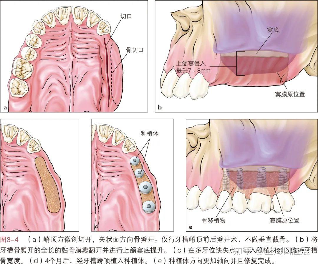 牙周炎患者埋伏牙拔除与牙槽嵴重建及种植修复一例 | 海奥种植长廊_治疗