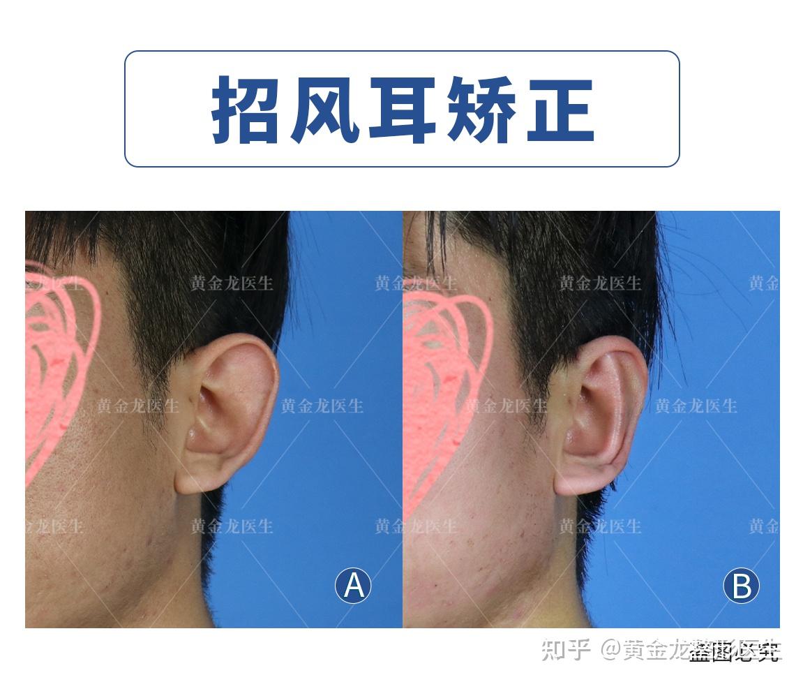 EELHOE 耳贴矫正器 耳朵显小支撑矫正招风耳耳廓定型防水耳贴-阿里巴巴