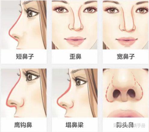 蒜头鼻、歪鼻和朝天鼻如何改善?做鼻综合有效吗?大概多少钱? - 知乎