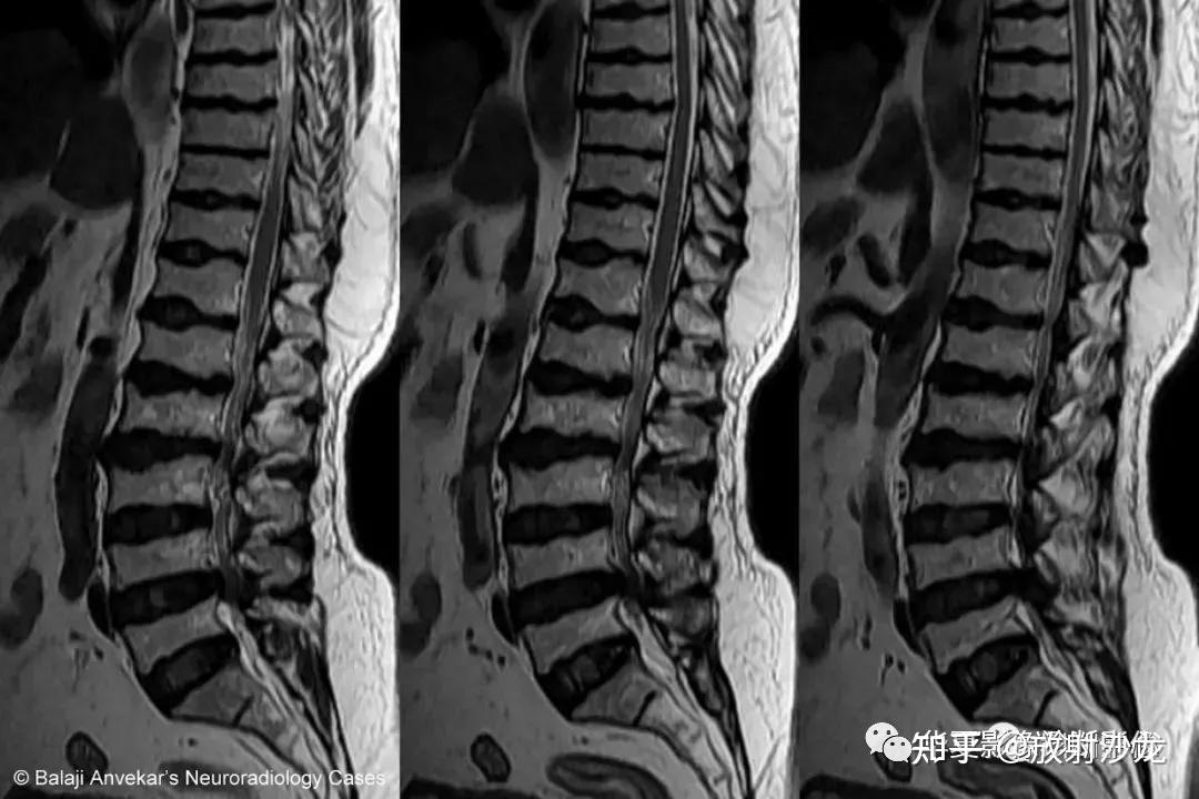 青少年腰疼不能忽視腰椎休門氏病