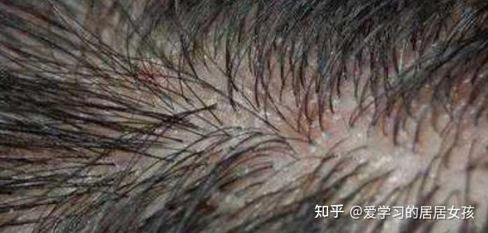 注意啦!!乱拔头发可能引发毛囊炎 - 知乎