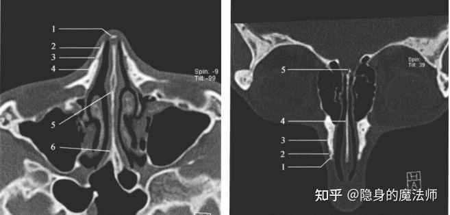 鼻骨正常图片图片