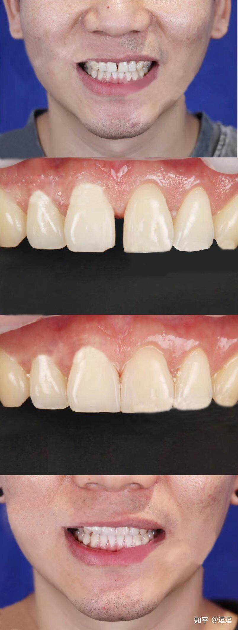 武汉仁爱口腔瓷贴面快速关闭门牙牙缝隙