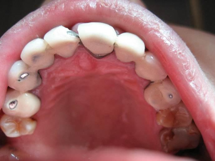 牙冠牙根牙颈图片图片