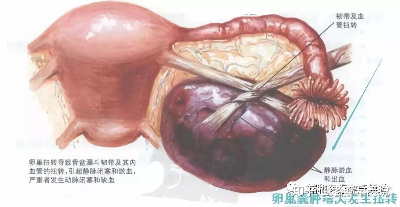 =正常发育的卵泡存留超过正常时间即可发生滤泡囊肿;或者卵巢黄体囊肿