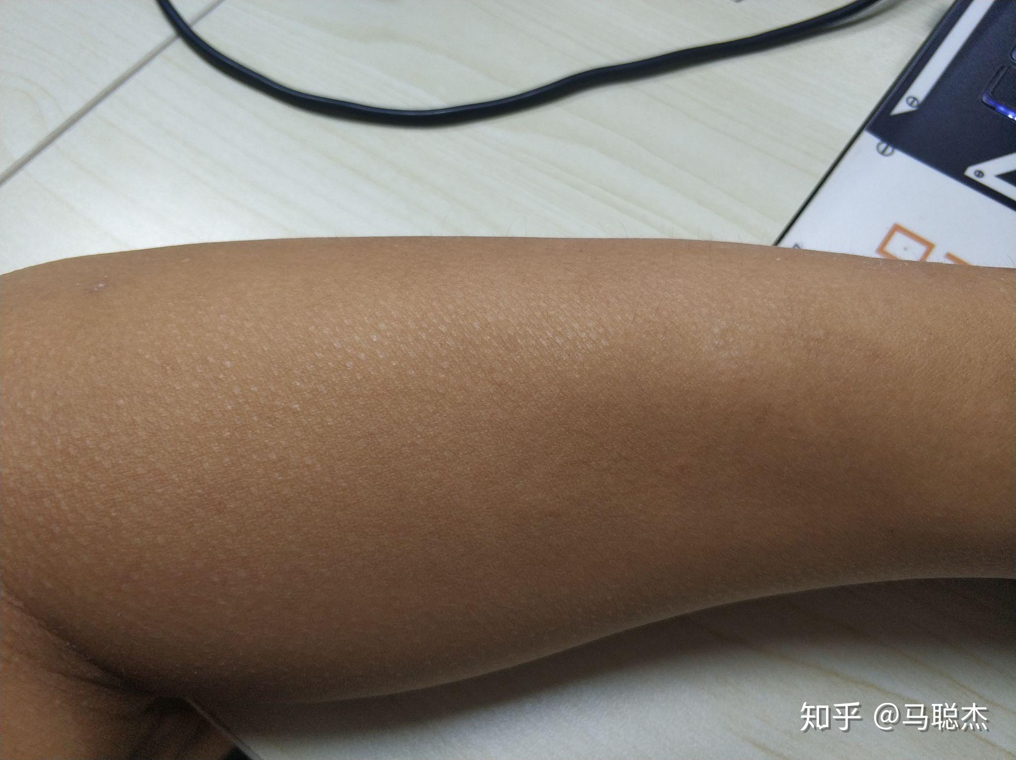 身上皮肤突然变粗糙像鸡皮(身上皮肤突然变粗糙像鸡皮肤一样)