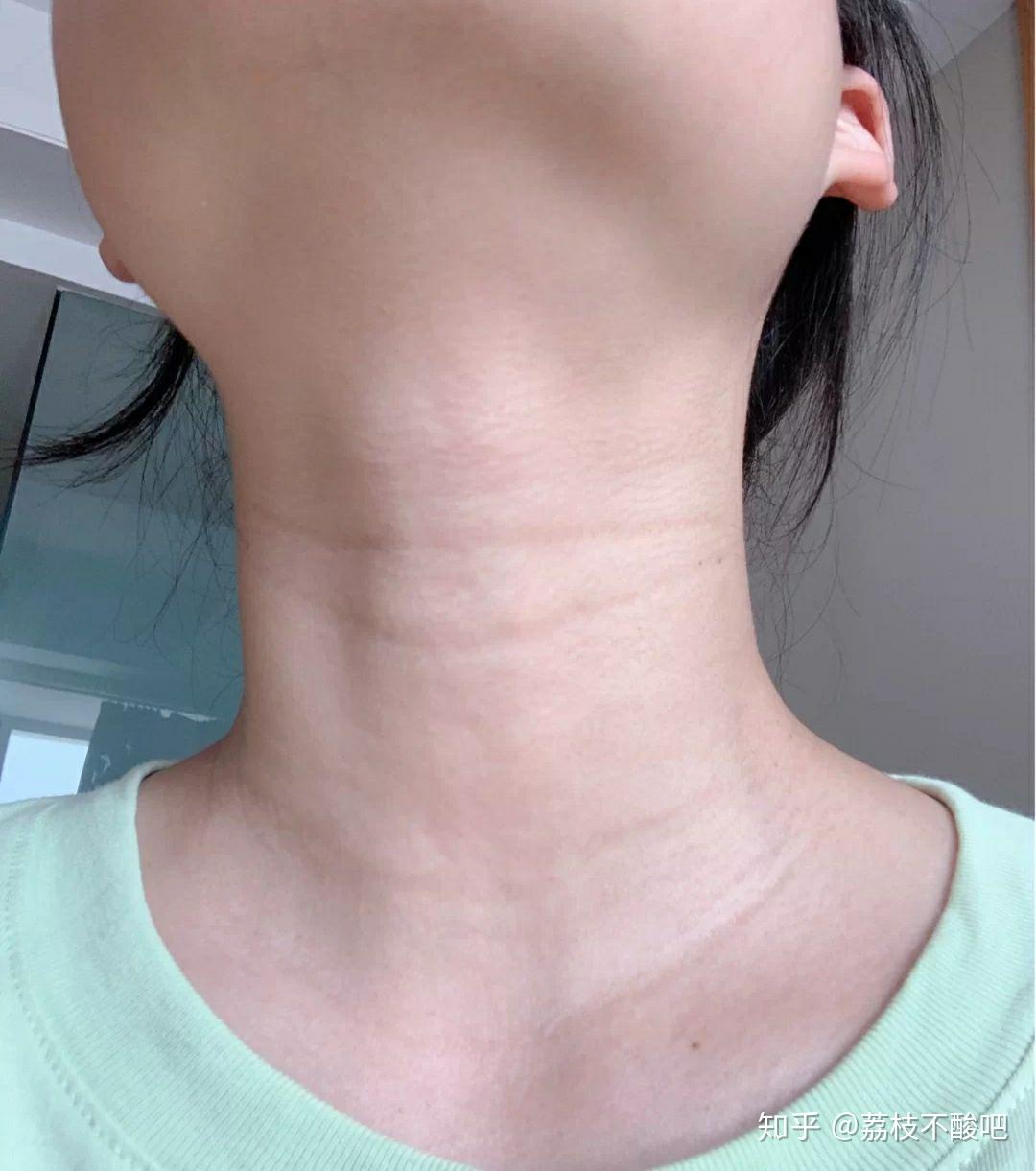 我才20岁,脖子又松弛皱纹有多,一圈圈很深的颈纹,怎么办? - 知乎