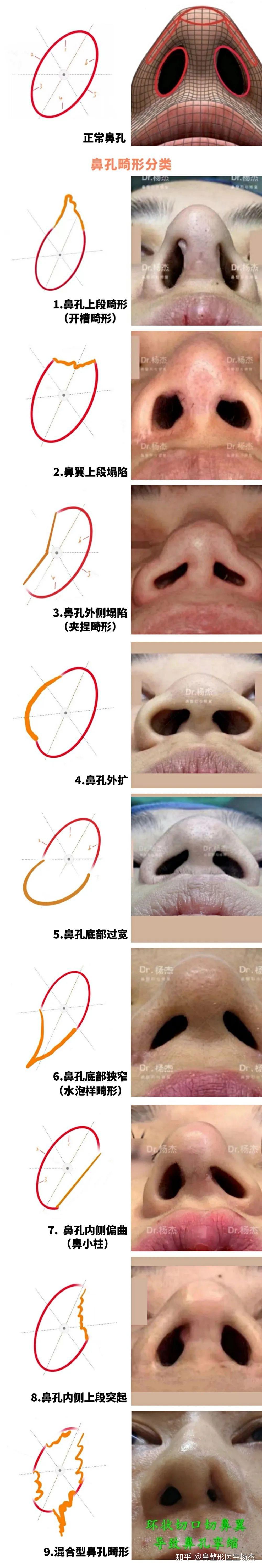 鼻孔常见畸形分类及治疗、预防原则 - 知乎