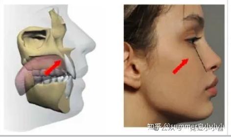 舌头贴上颚,能让鼻基底变高、脸变立体变好看? - 知乎