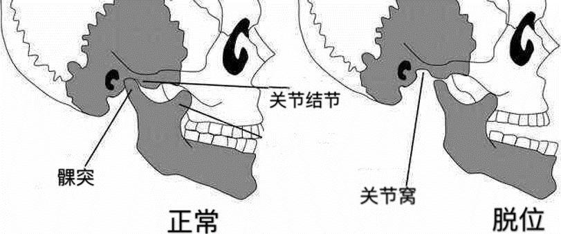 颞下颌关节位置图图片