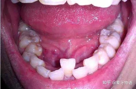 梦境与现实的交织，梦见牙齿掉了一颗下牙，意味着什么？