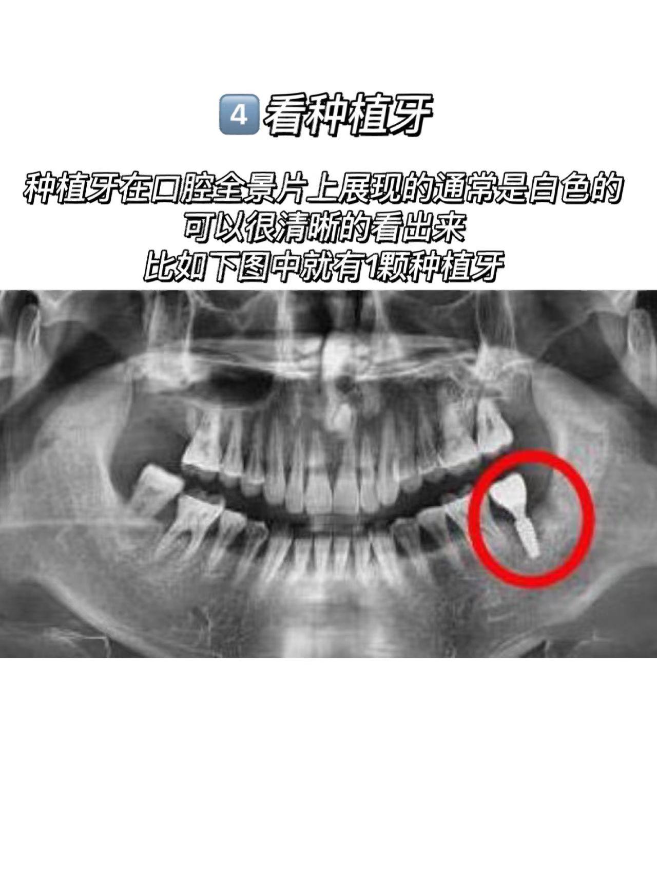 如何看牙科的X光片？牙片详解，教你看懂牙片！_口腔_牙齿_全景
