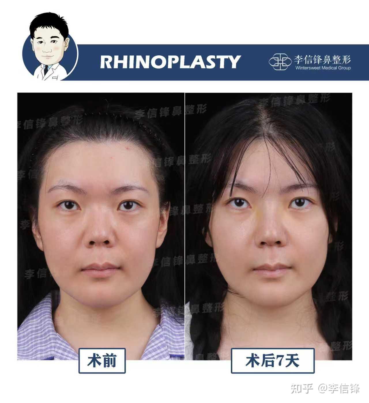 初鼻鼻综合-短鼻朝天、漏鼻孔,鼻基底凹陷改善,术后七天对比~ - 知乎