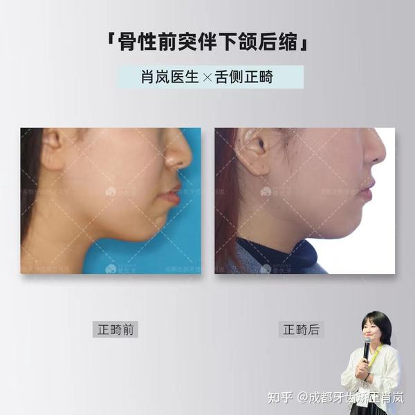 舌侧正畸,单纯矫正能不能改善下颌后缩? - 知乎