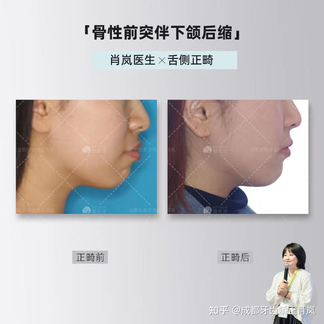 舌侧正畸，单纯矫正能不能改善下颌后缩？ - 知乎