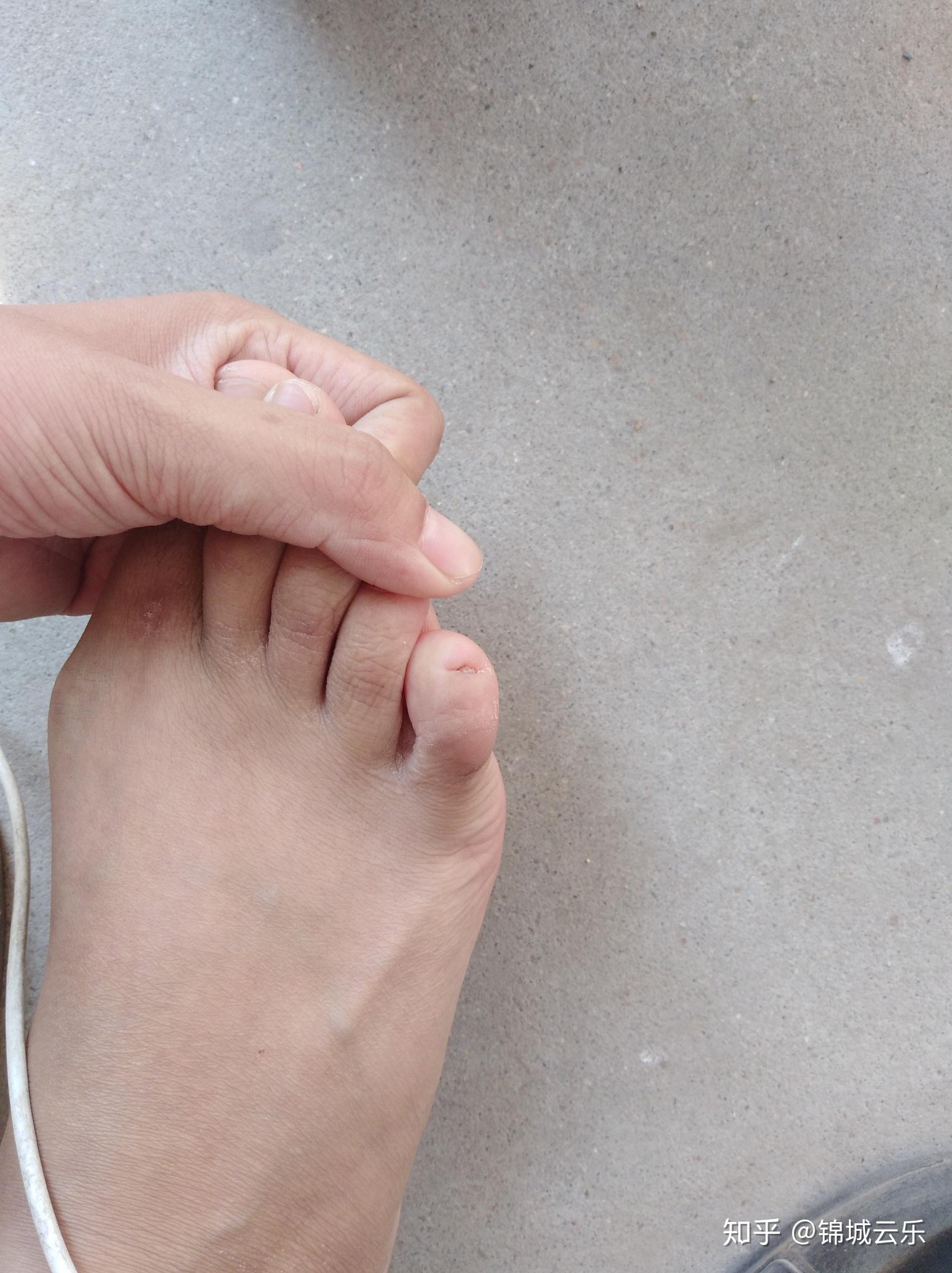 畸形脚指甲恢复过程 - 知乎
