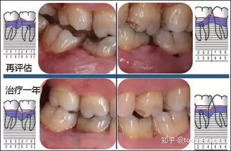 药物性牙龈肥大序列治疗一例