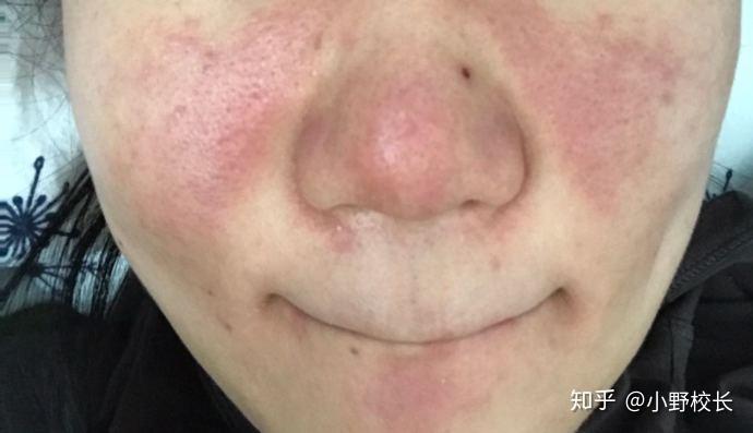 玫瑰痤疮敏感肌过敏肌答疑篇