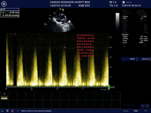 室间隔缺损超声图解图片