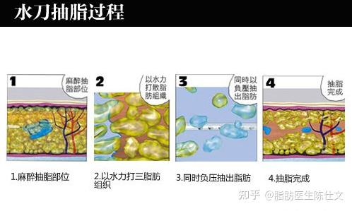 面部吸脂手术能改善脸型吗 知乎