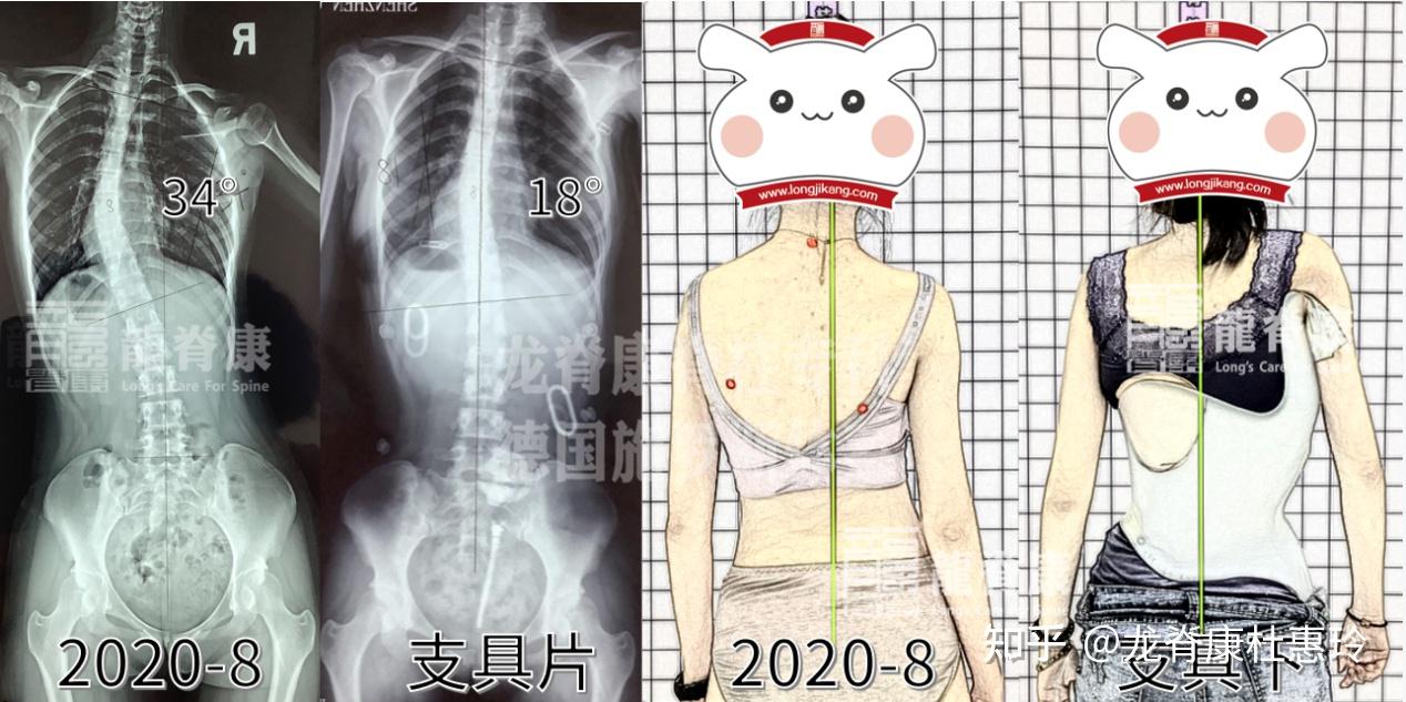 臨床上,青少年脊柱側彎cobb角>20°或者脊柱側彎惡化風險因子>1.