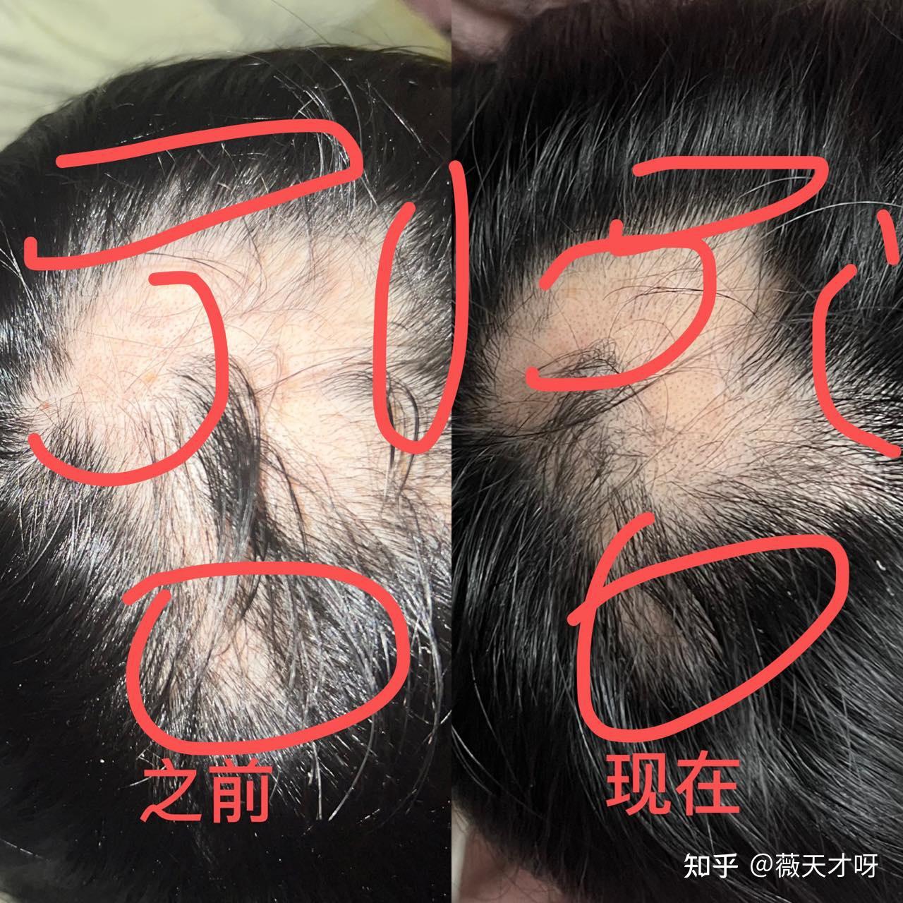 斑秃长出头发来了!