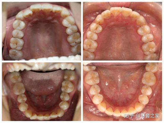 牙齿对刃有什么危害?