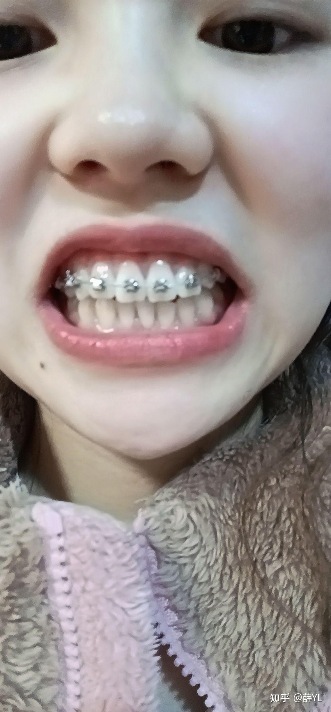 2021930虎牙矫正记录