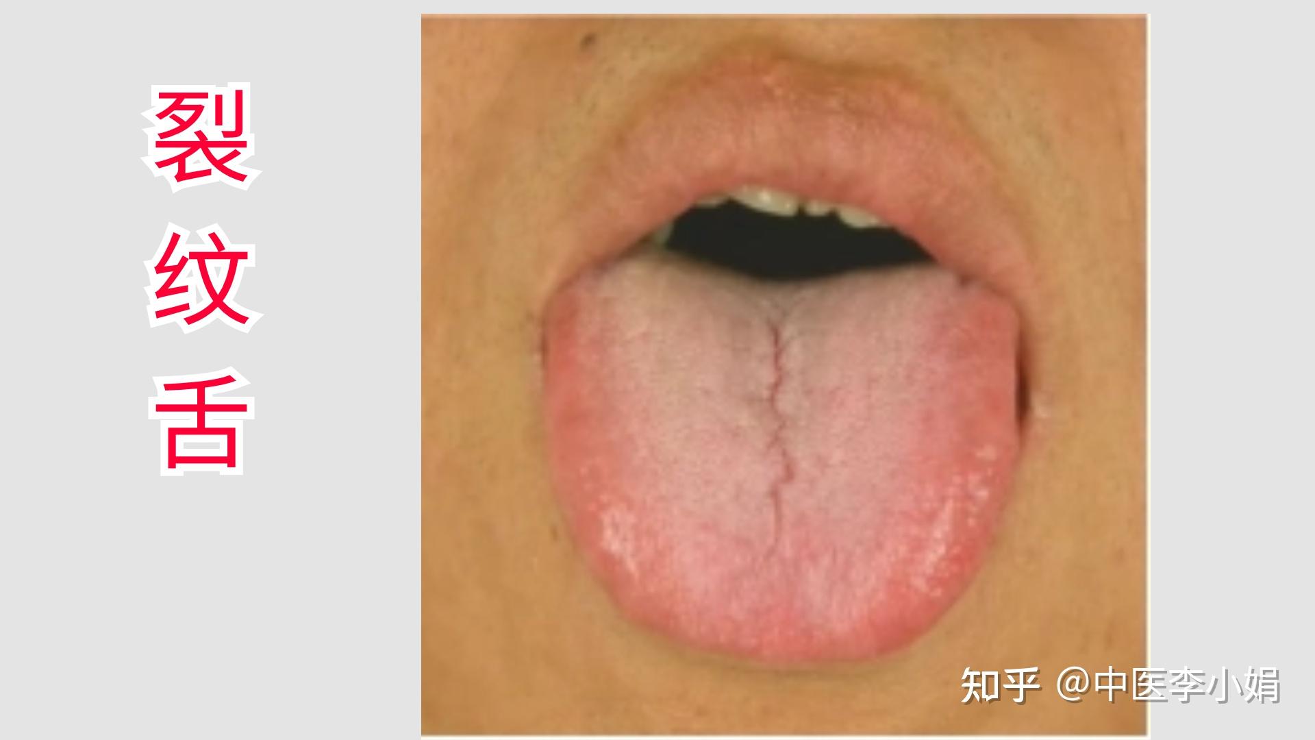 身体该不该补,舌头知道!如果你是这3种舌象,小心越补越糟 - 知乎