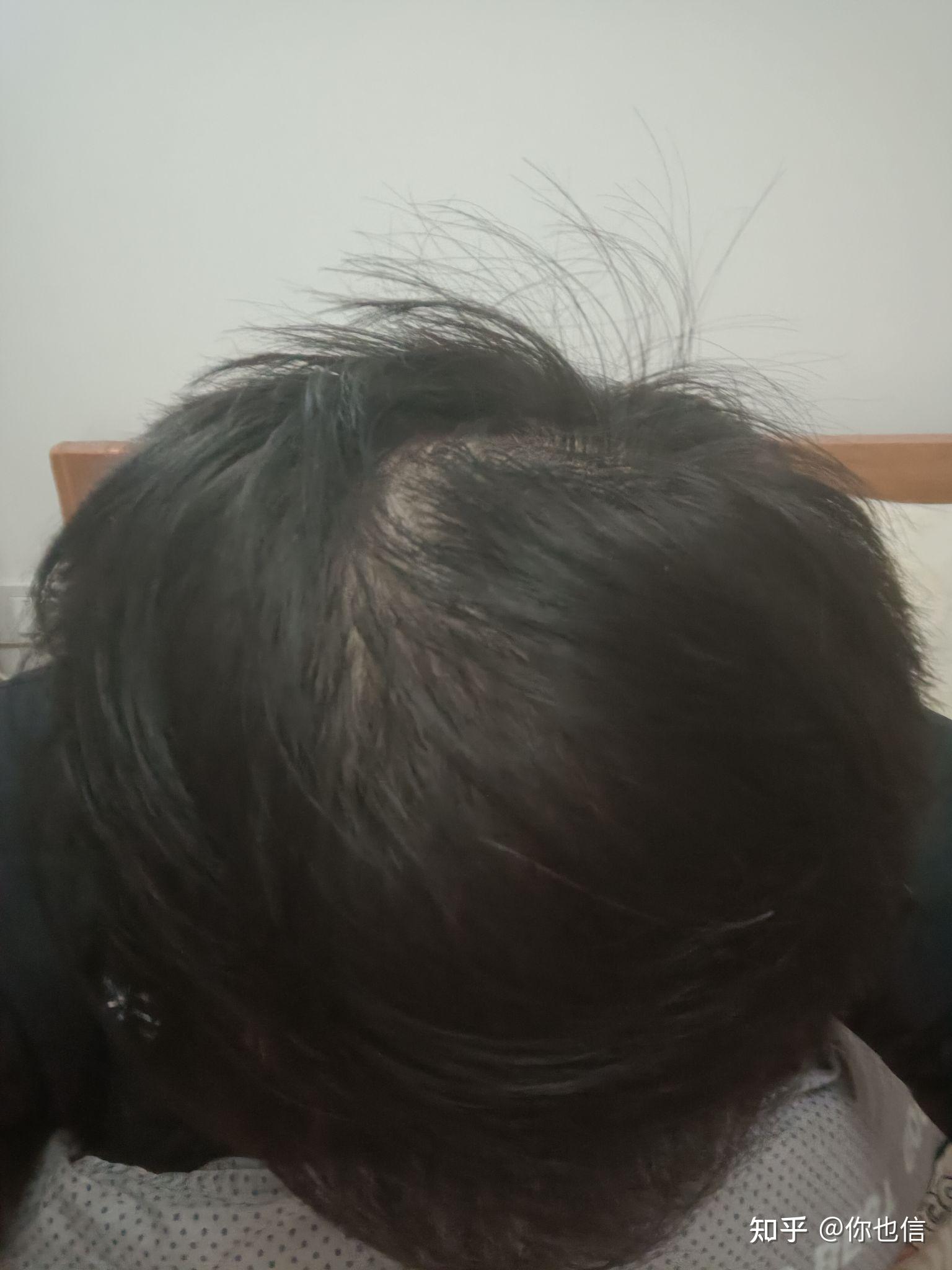 三个多月,从快秃顶到正常发量,幸好在治疗脱发上我没有走弯路,感谢