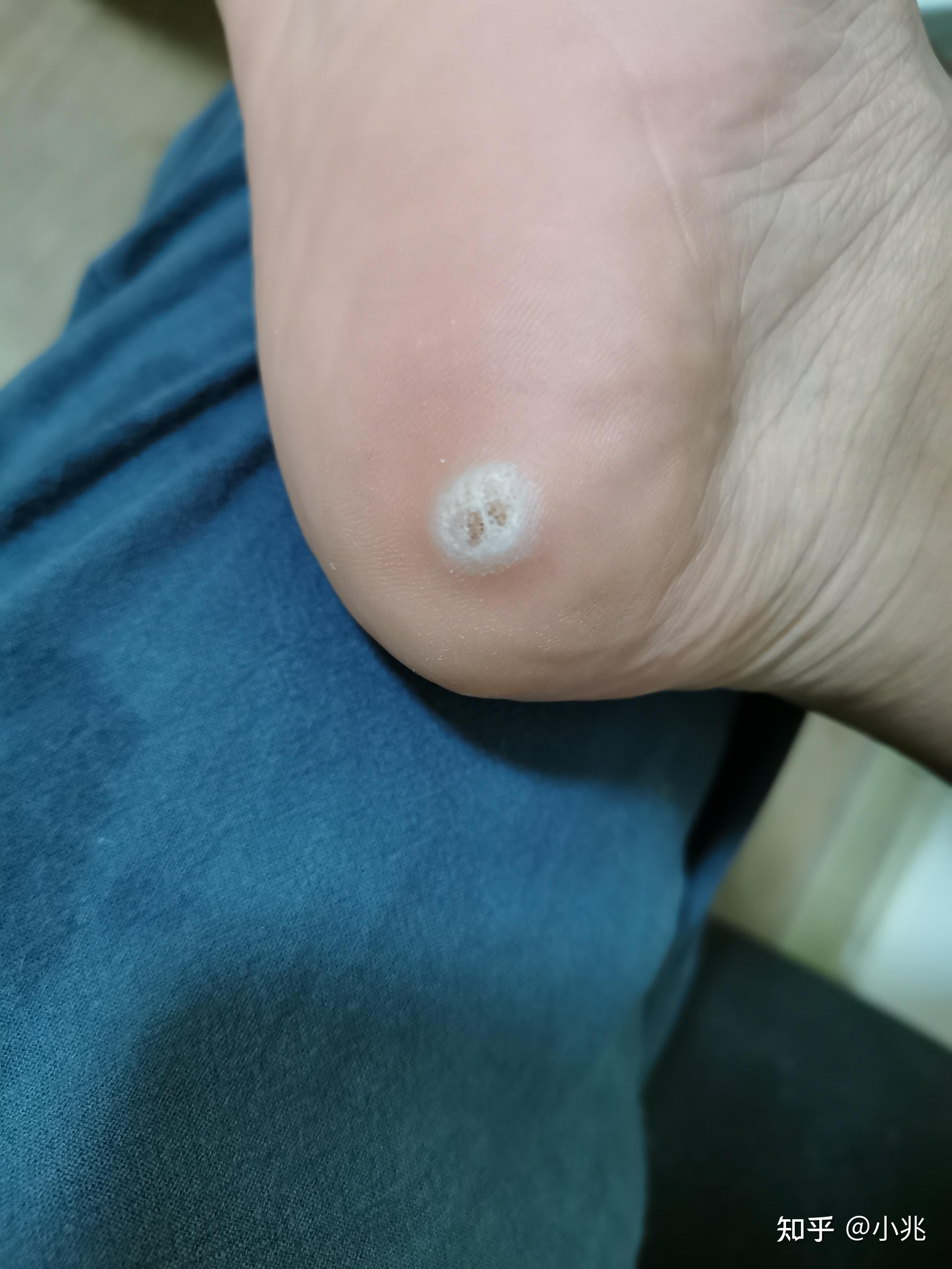 跖疣的激光治疗