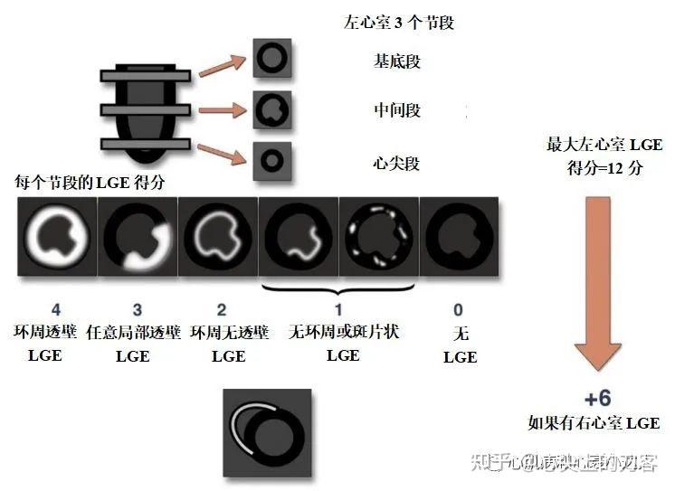 Qale 心脏淀粉样变的辅助检查4——常规心脏磁共振检查 - 知乎